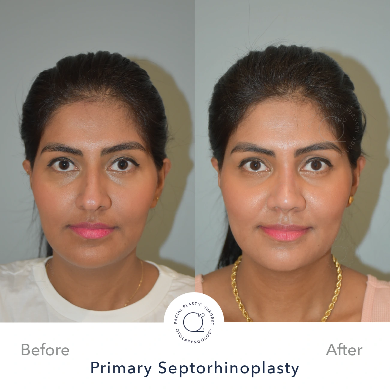 Rinoplastia Madrid caso 23 fotografía 4