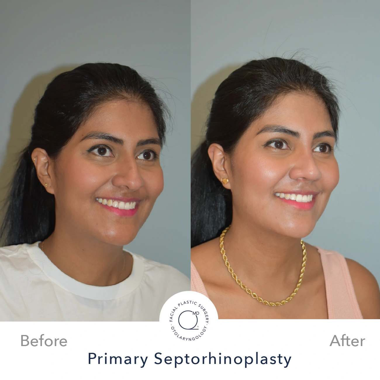 Rinoplastia Madrid caso 23 fotografía 5