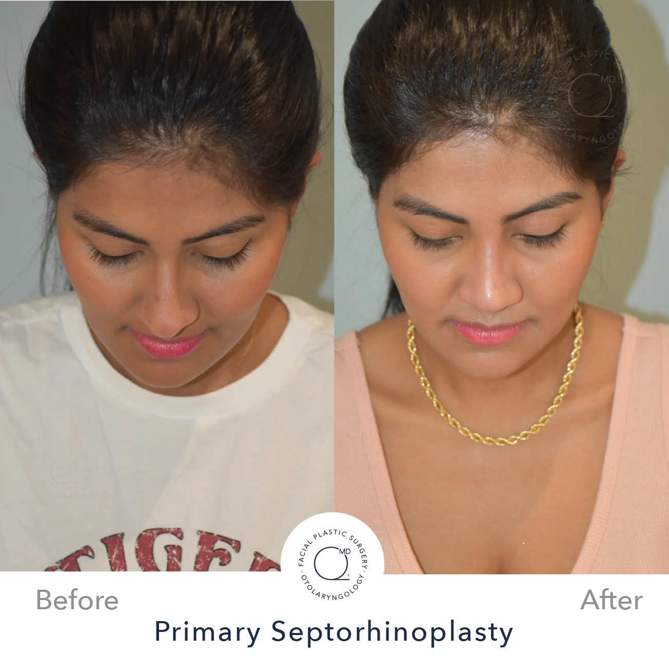 Rinoplastia Madrid caso 23 fotografía 6