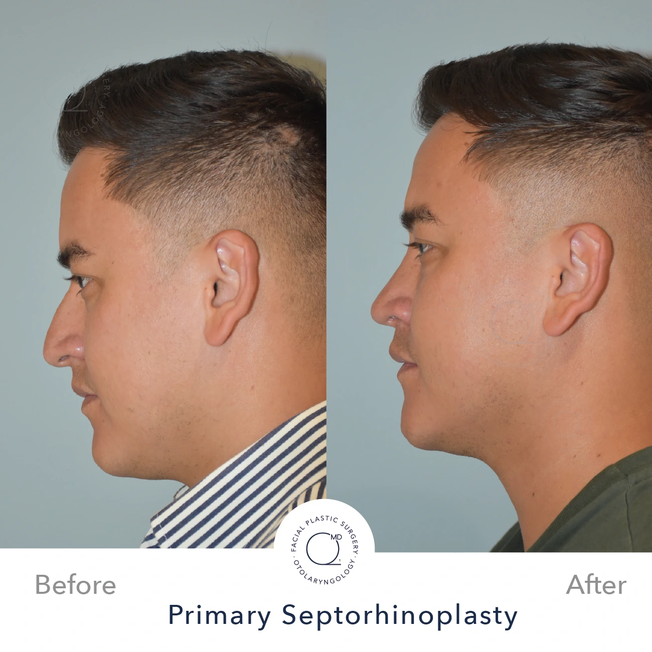 Rinoplastia Madrid caso 24 fotografía 3