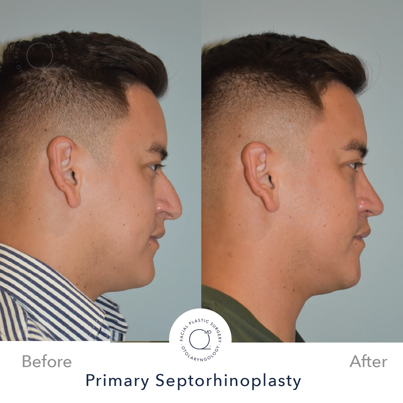 Rinoplastia Madrid caso 24 fotografía 4