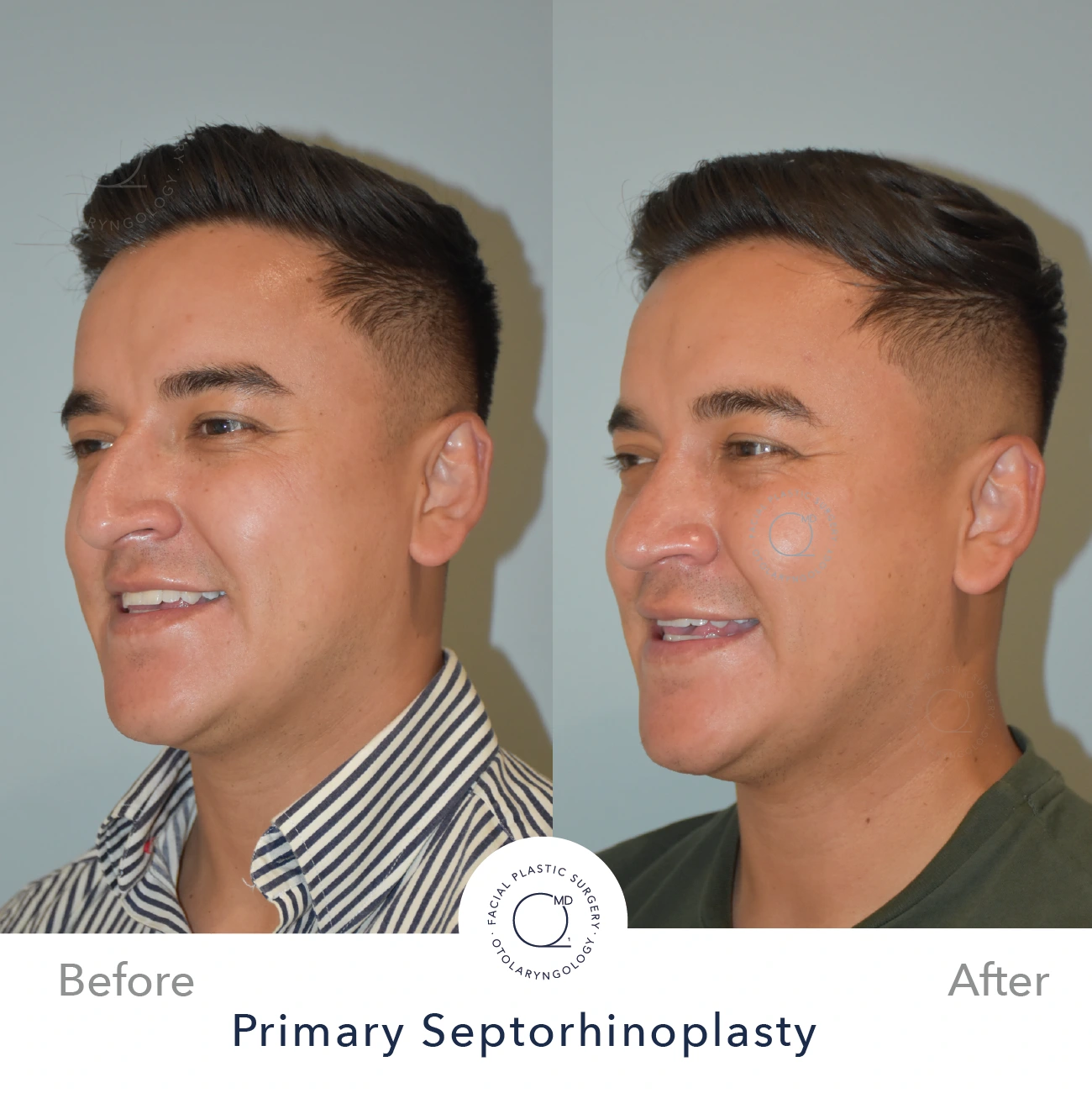 Rinoplastia Madrid caso 24 fotografía 5
