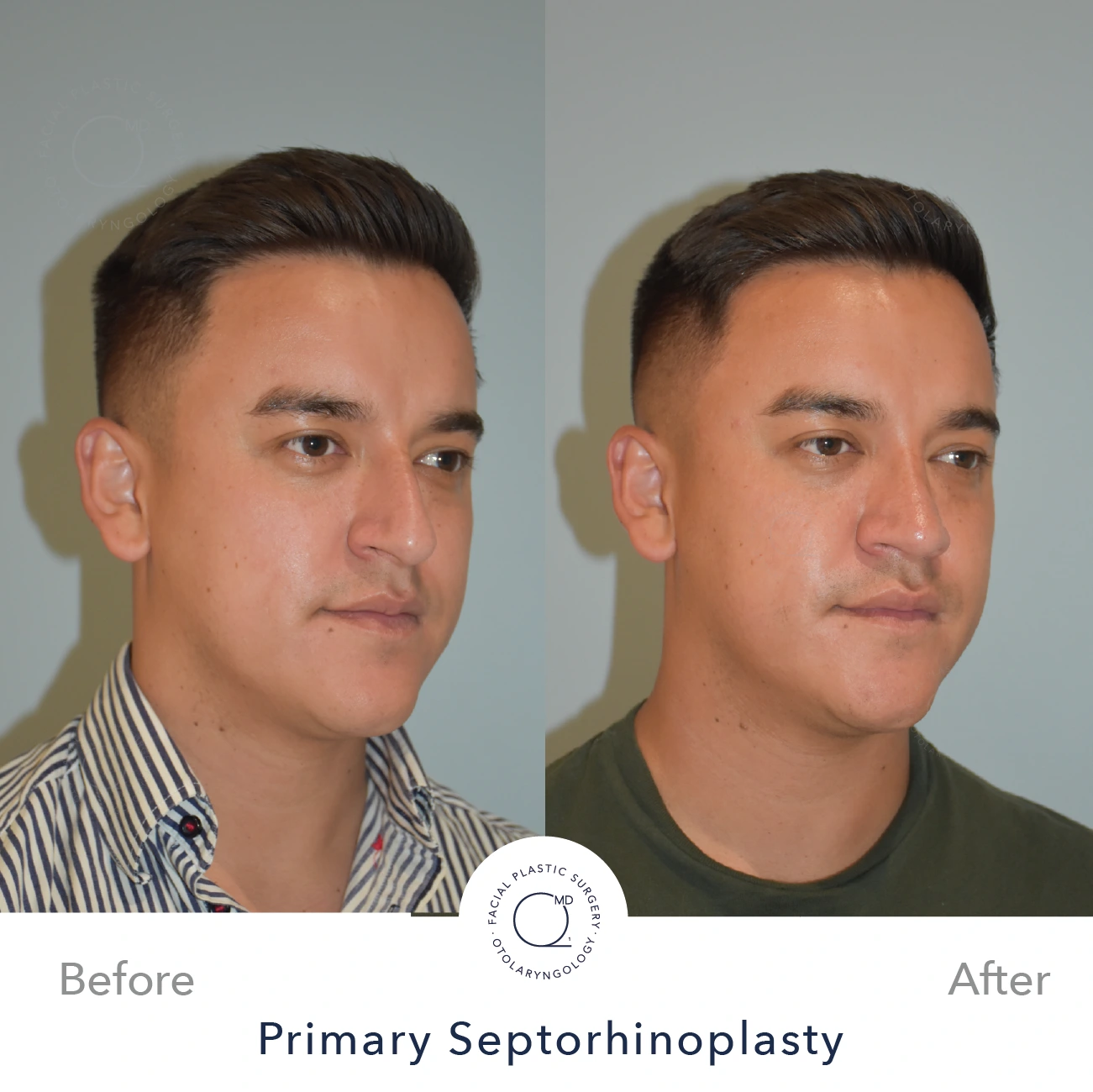 Rinoplastia Madrid caso 24 fotografía 6