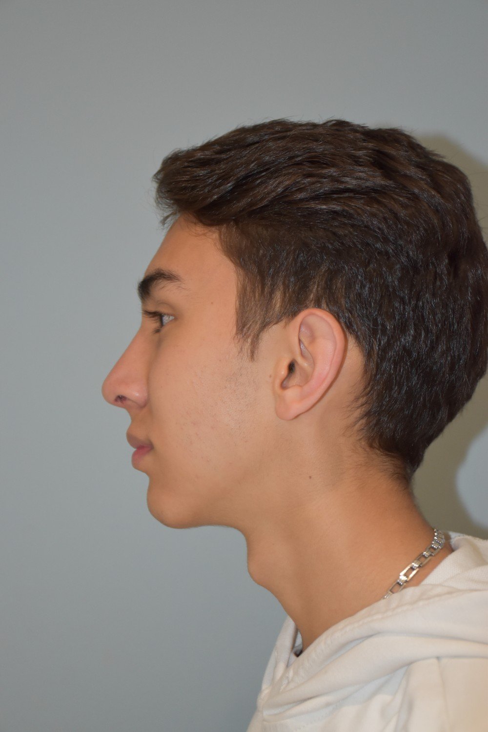 Rinoplastia Madrid caso 25 fotografía 2