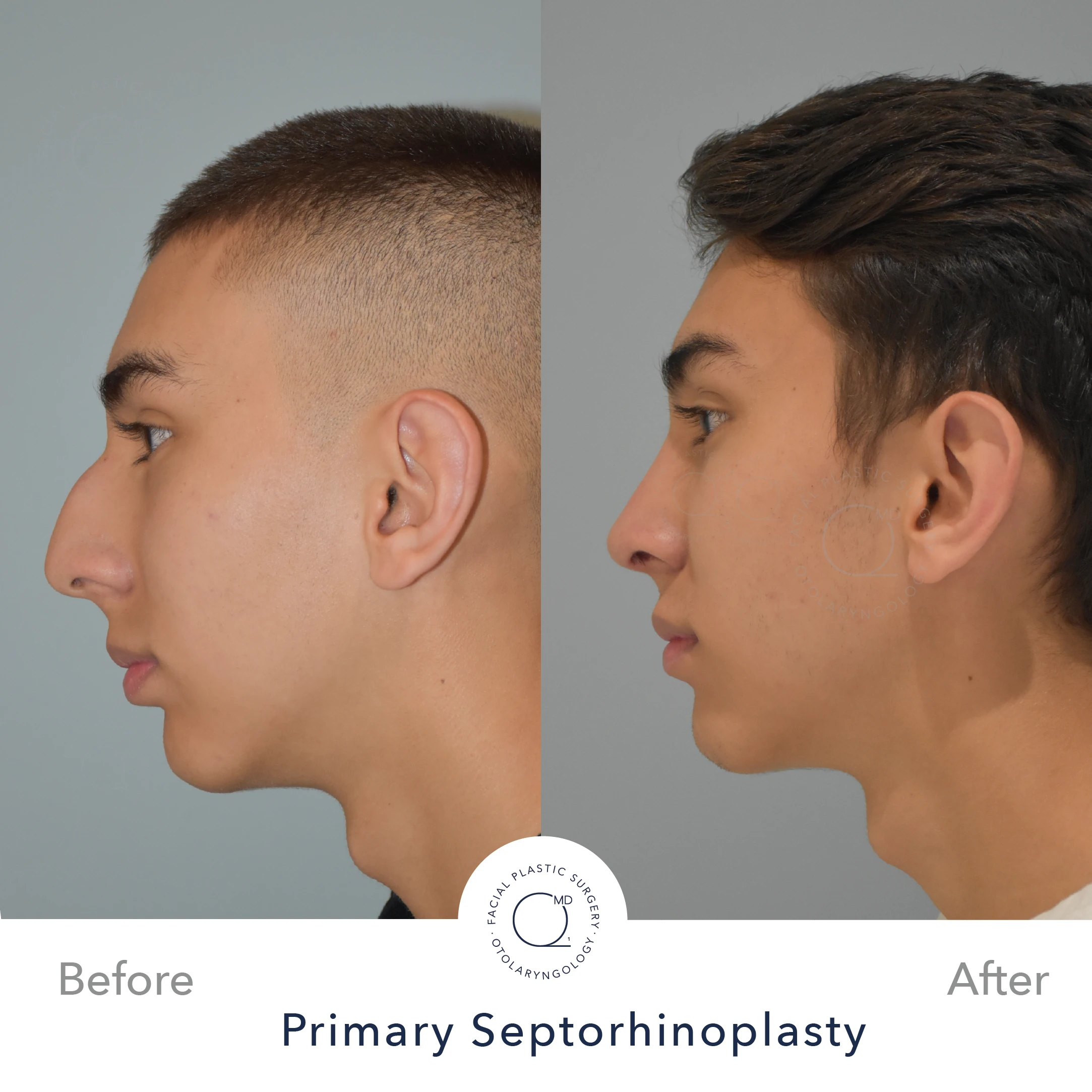 Rinoplastia Madrid caso 25 fotografía 3