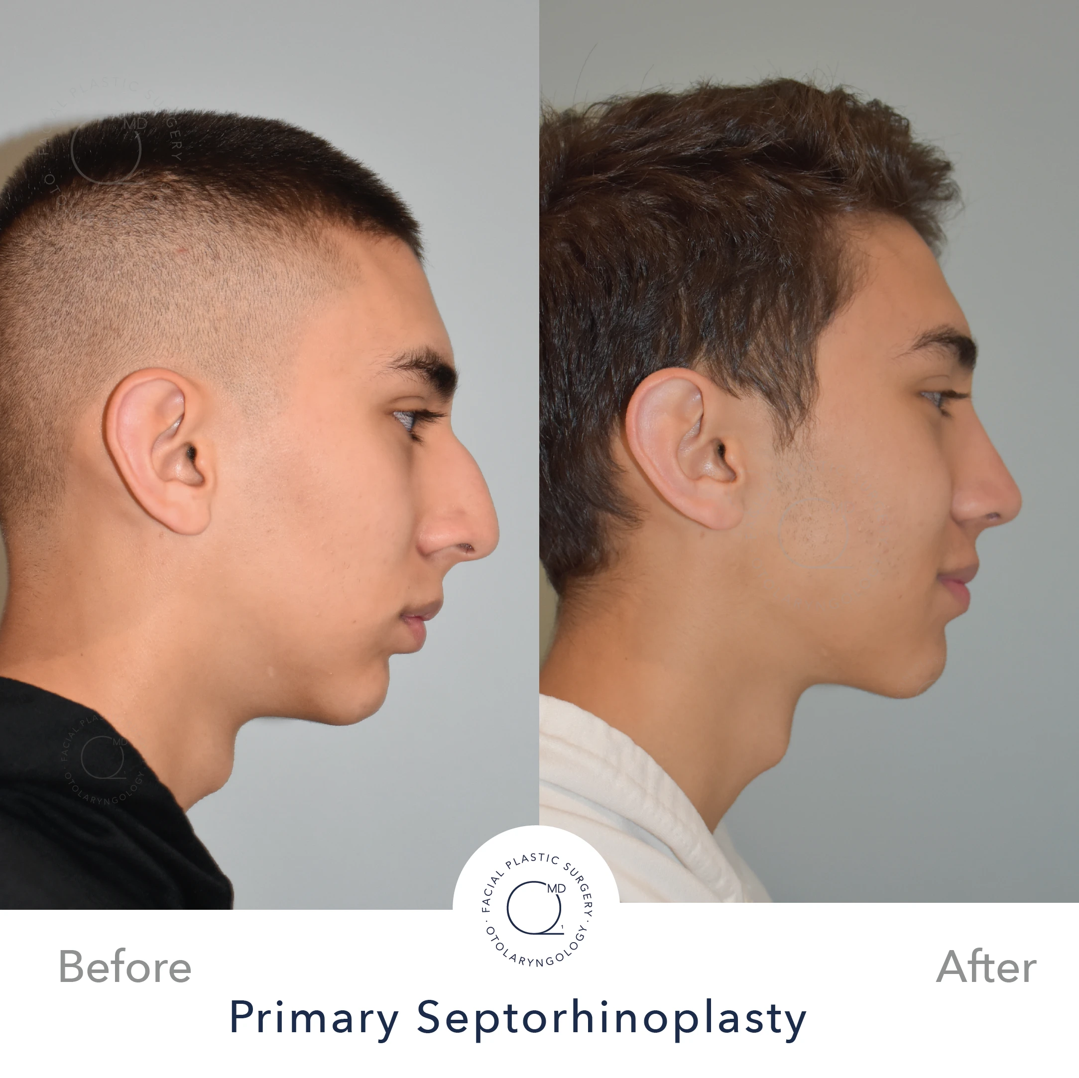 Rinoplastia Madrid caso 25 fotografía 4
