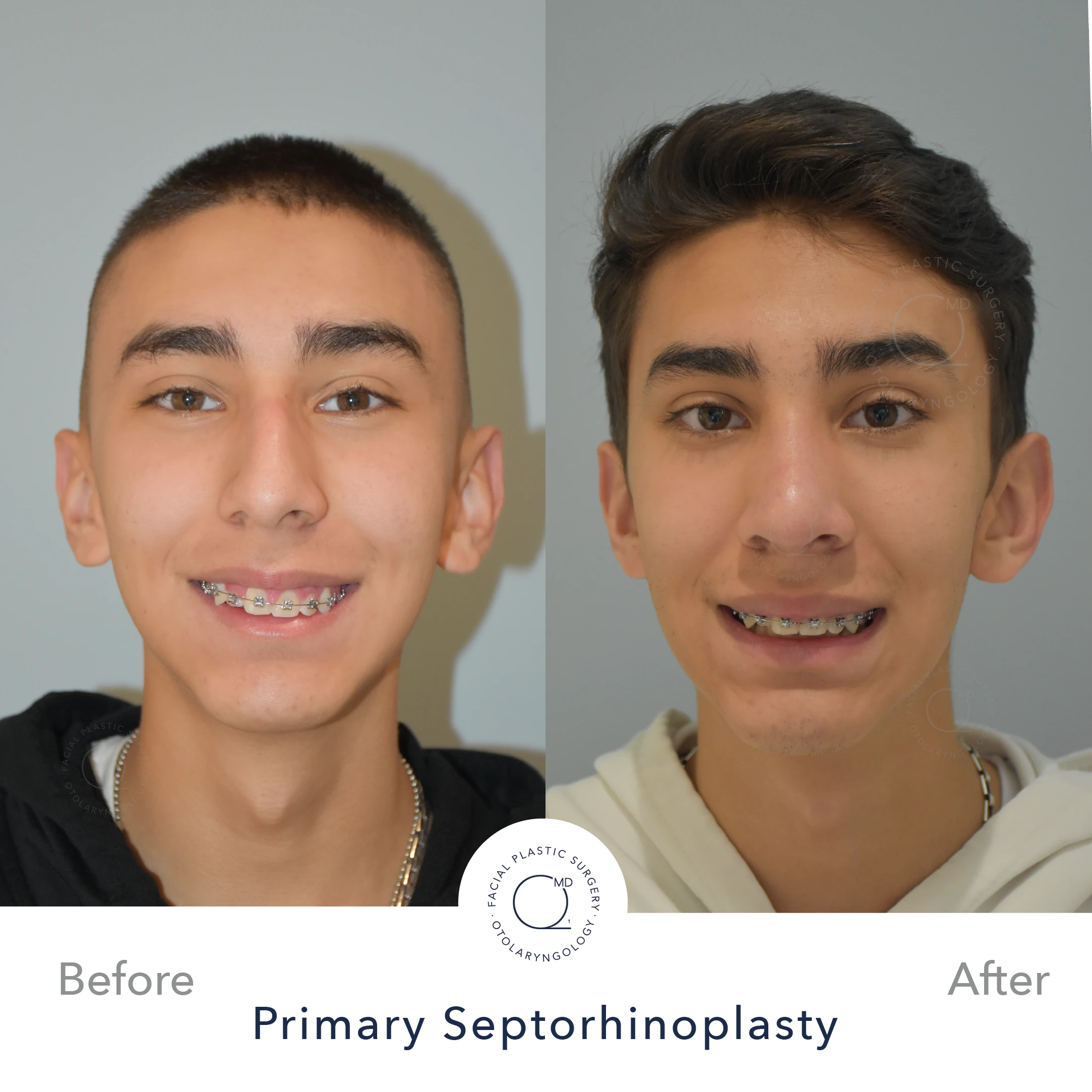 Rinoplastia Madrid caso 25 fotografía 5