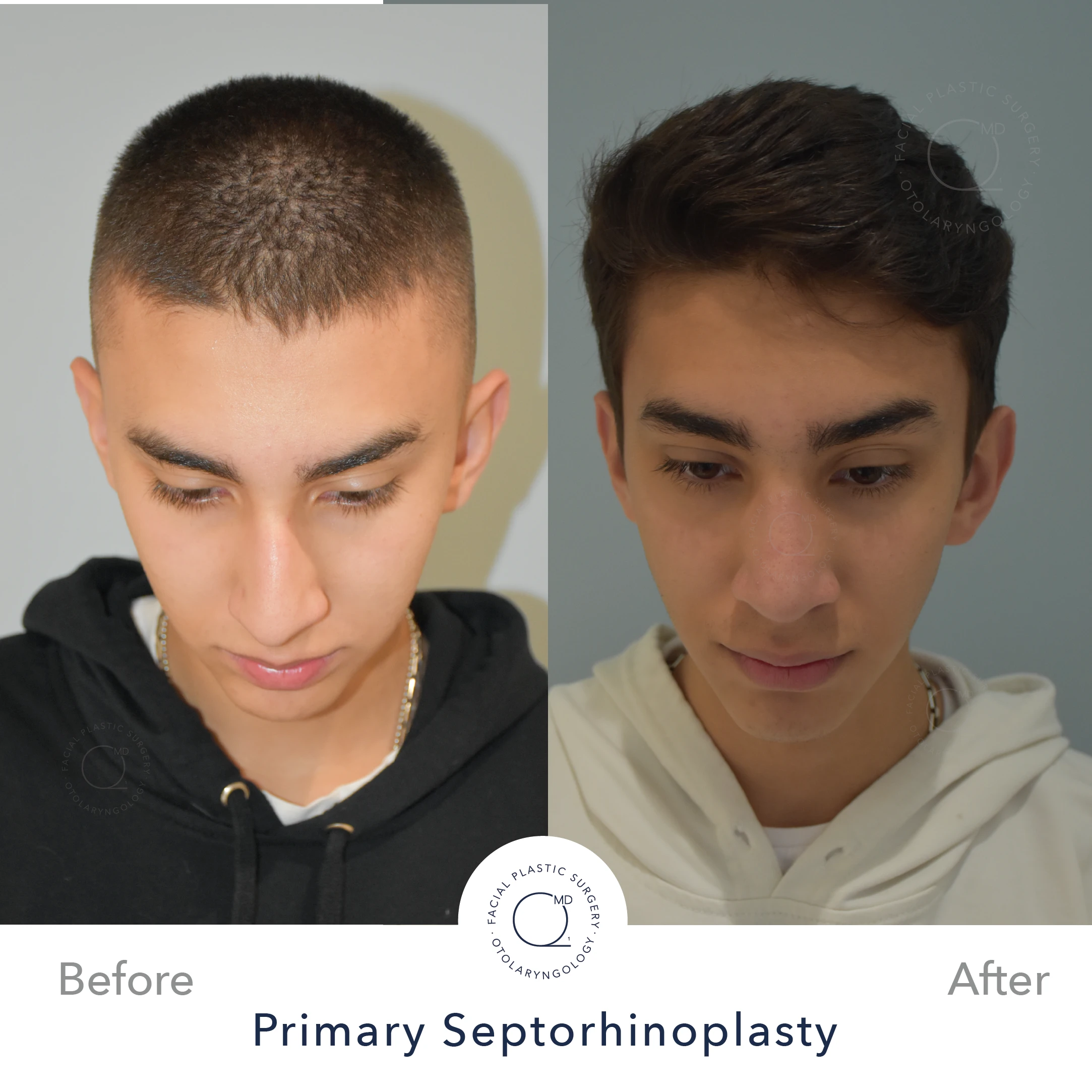 Rinoplastia Madrid caso 25 fotografía 6