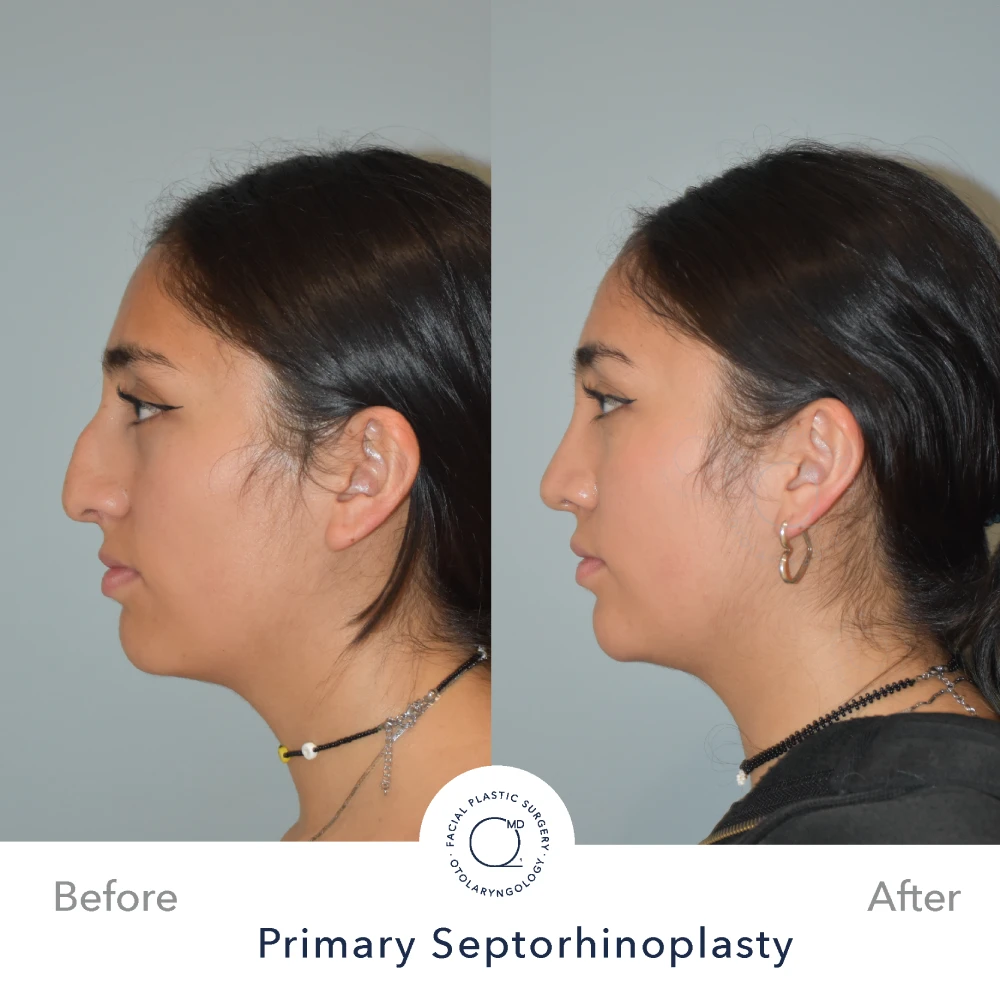 Rinoplastia Madrid caso 26 fotografía 3