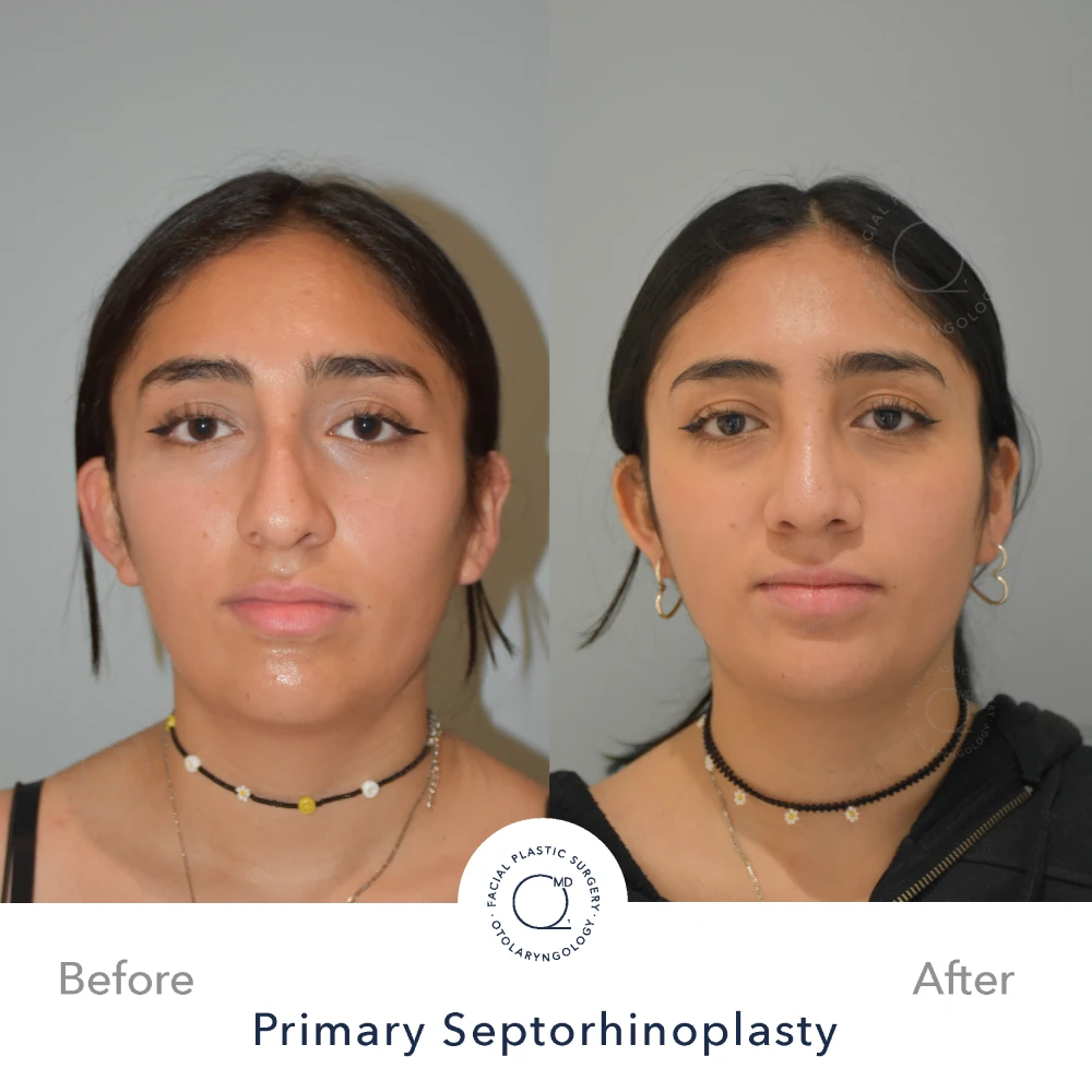 Rinoplastia Madrid caso 26 fotografía 4