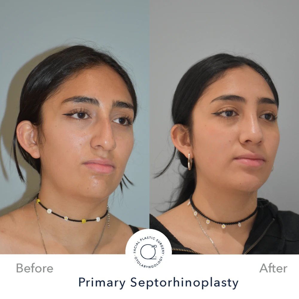 Rinoplastia Madrid caso 26 fotografía 5