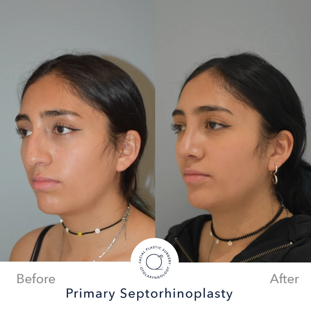 Rinoplastia Madrid caso 26 fotografía 6