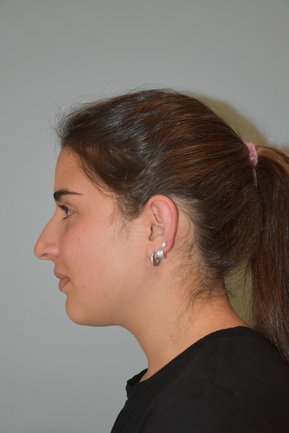 Rinoplastia Madrid caso 27 fotografía 1