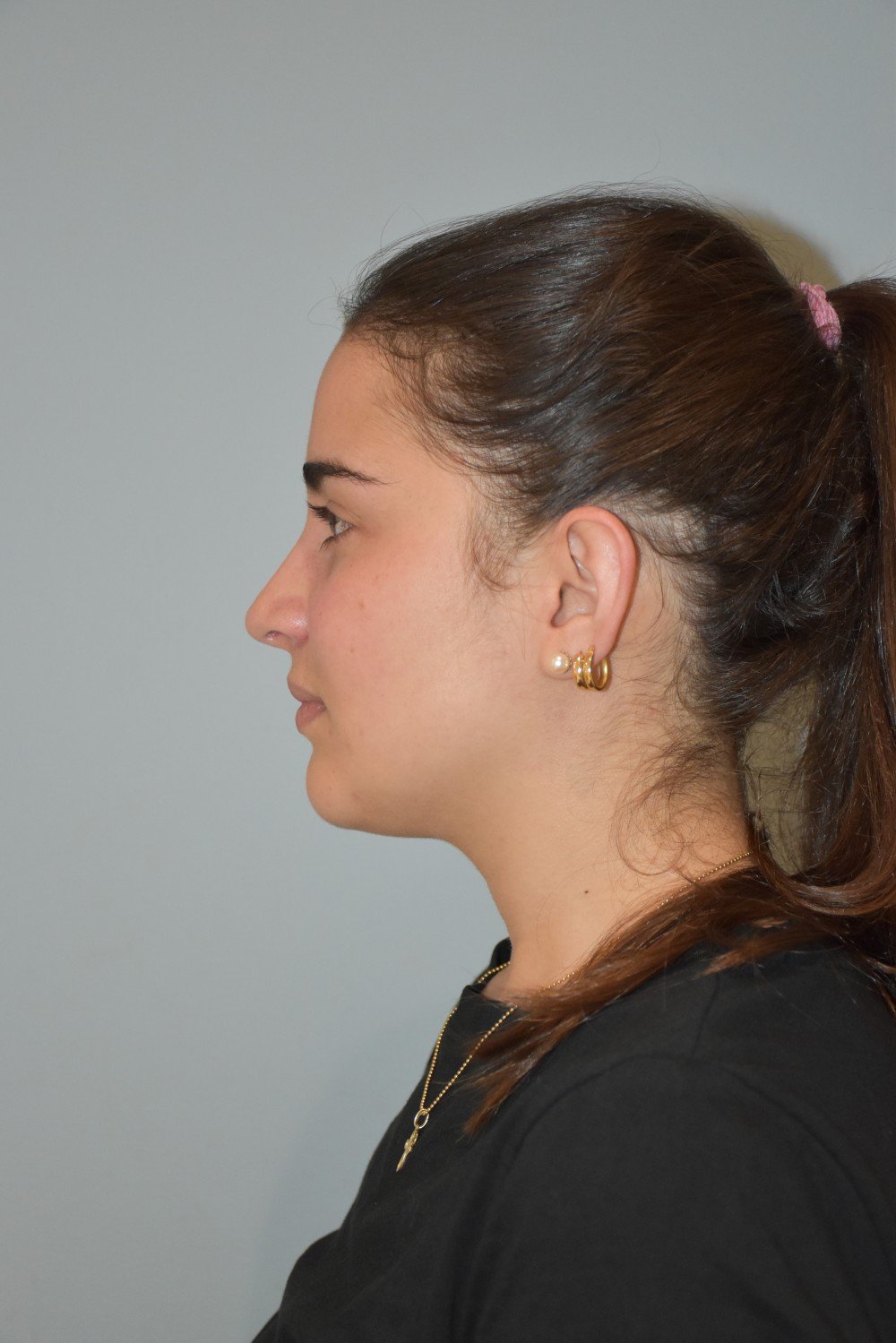 Rinoplastia Madrid caso 27 fotografía 2