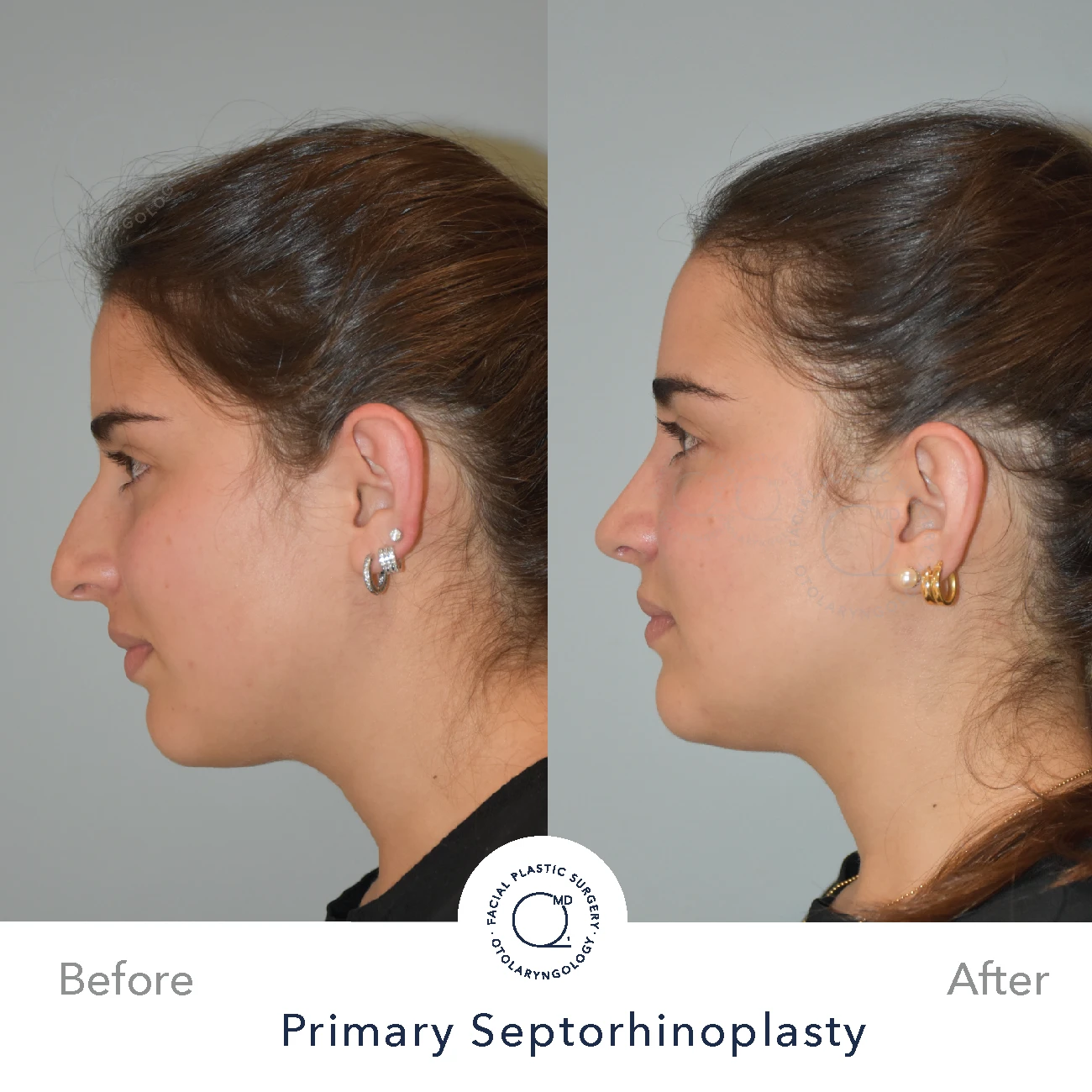 Rinoplastia Madrid caso 27 fotografía 3