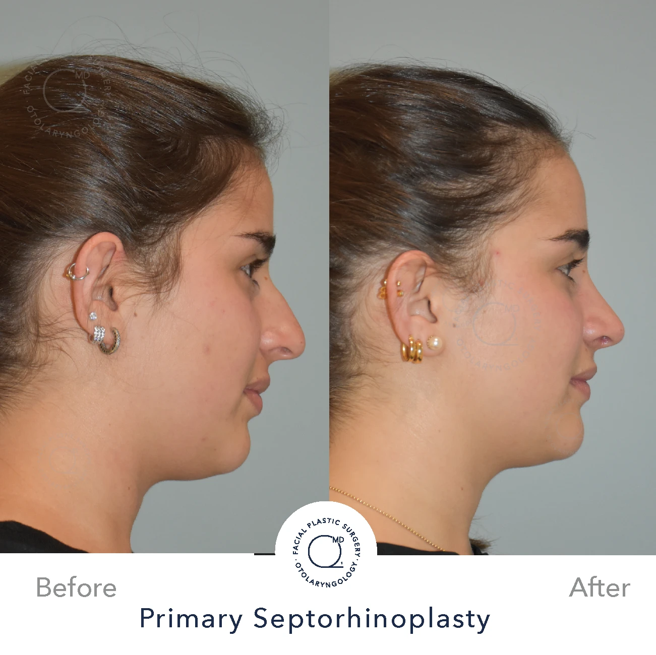 Rinoplastia Madrid caso 27 fotografía 4