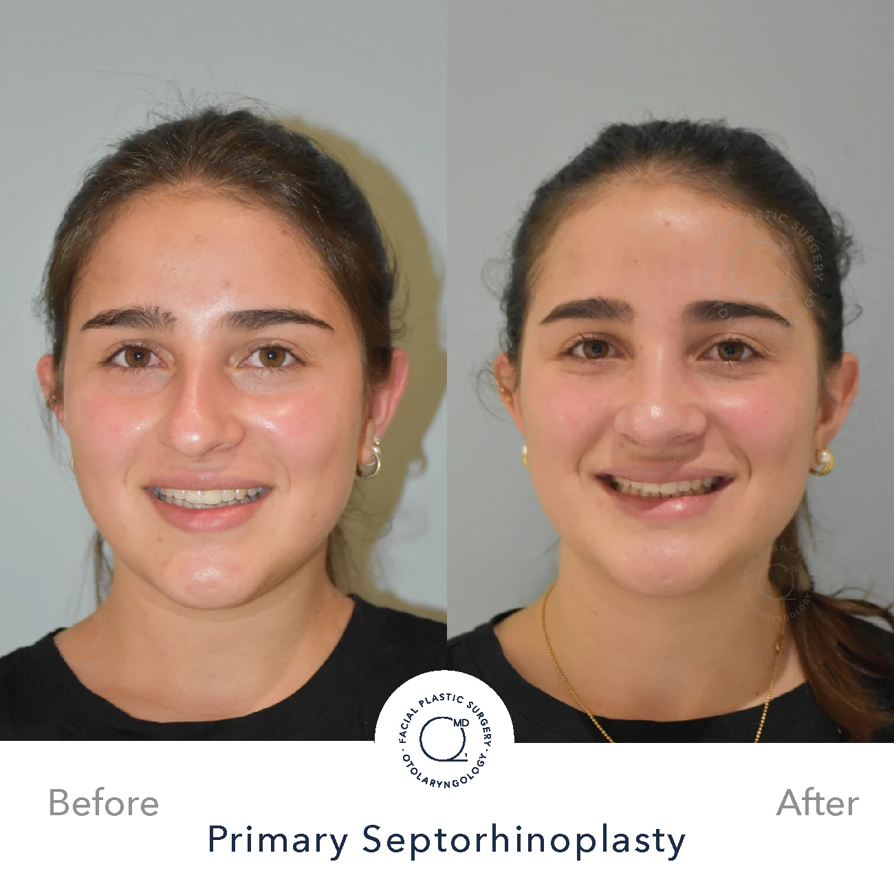 Rinoplastia Madrid caso 27 fotografía 5