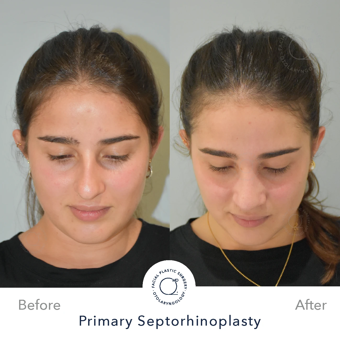 Rinoplastia Madrid caso 27 fotografía 6