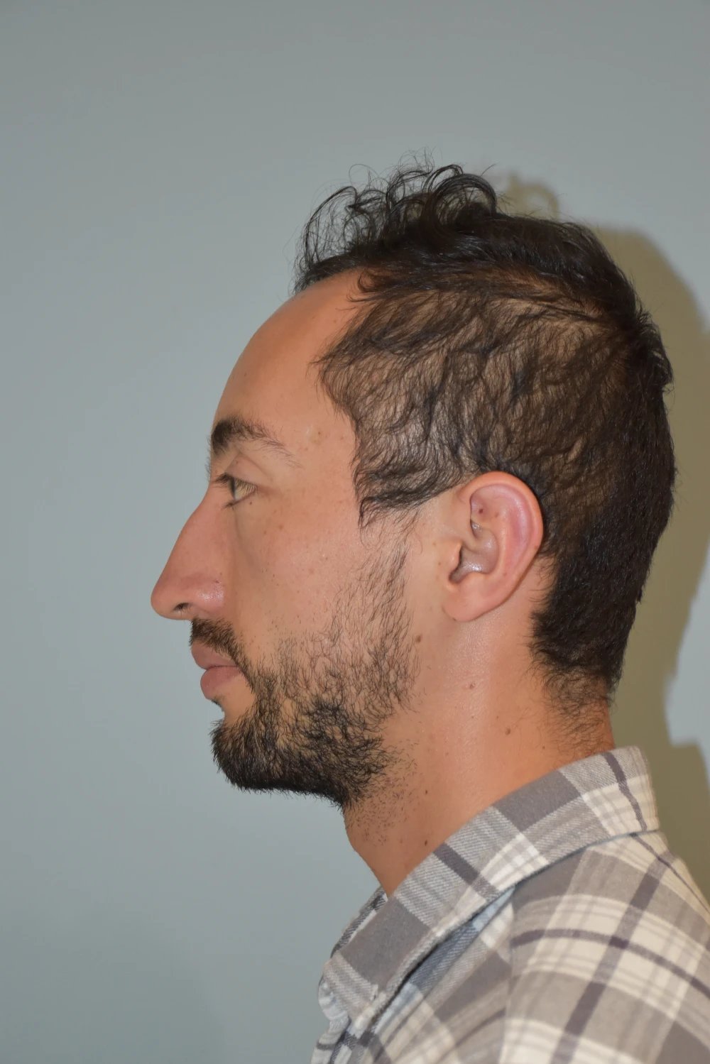 Rinoplastia Madrid caso 28 fotografía 1