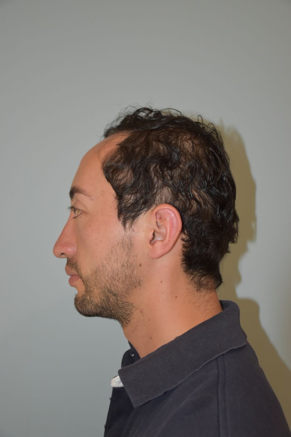 Rinoplastia Madrid caso 28 fotografía 2
