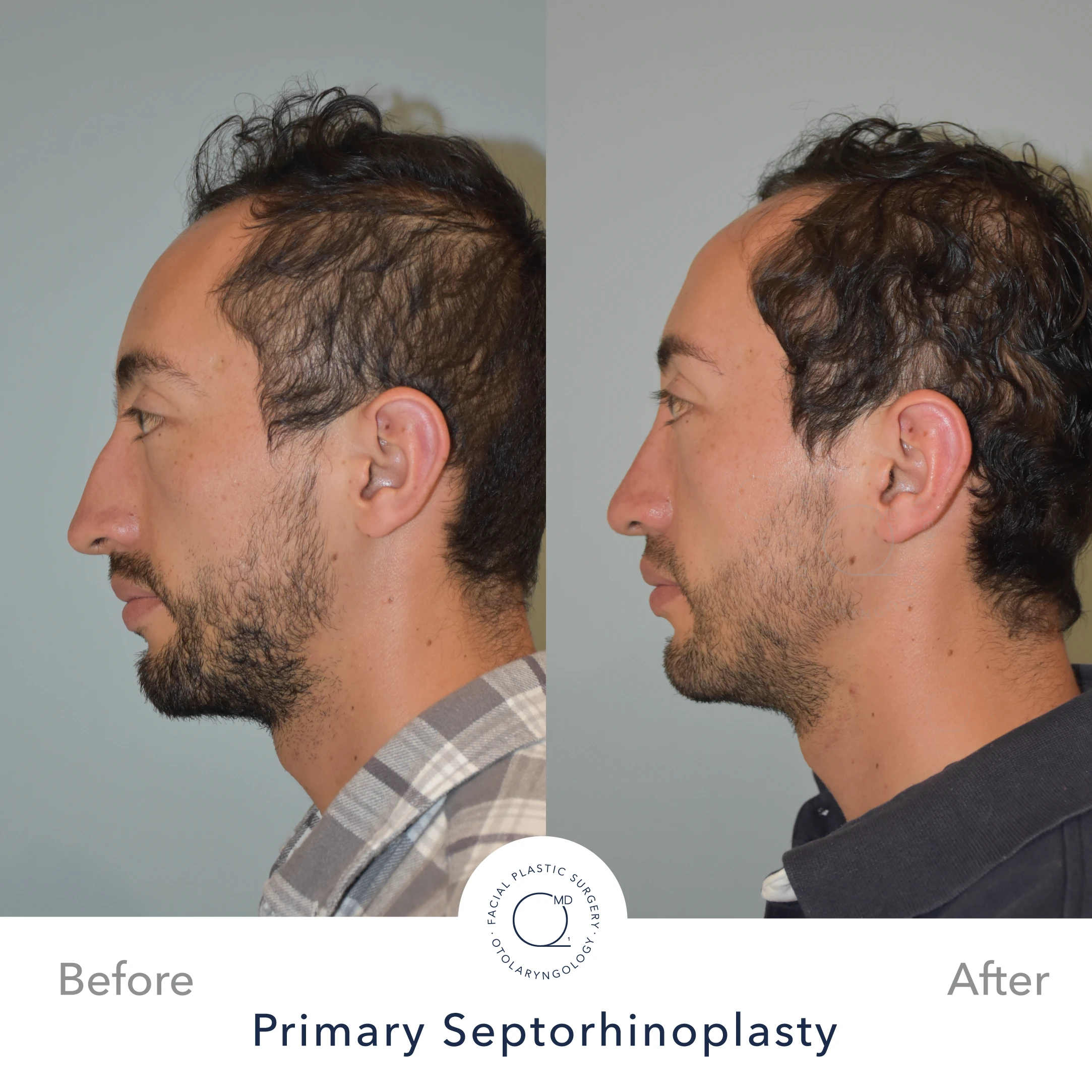 Rinoplastia Madrid caso 28 fotografía 3