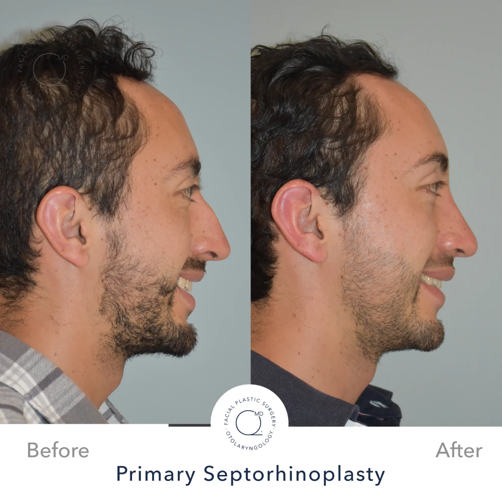 Rinoplastia Madrid caso 28 fotografía 4
