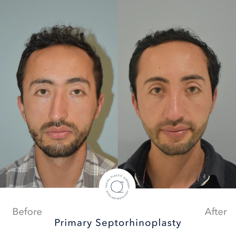 Rinoplastia Madrid caso 28 fotografía 5
