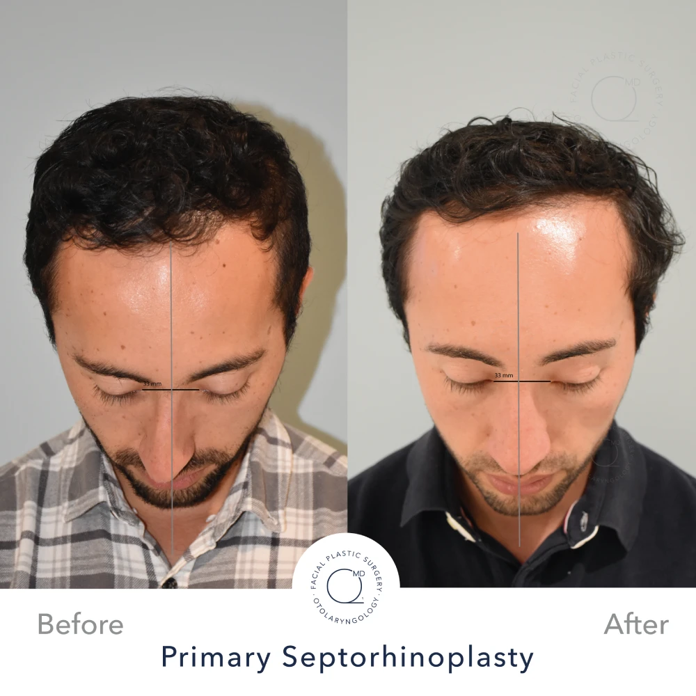 Rinoplastia Madrid caso 28 fotografía 6