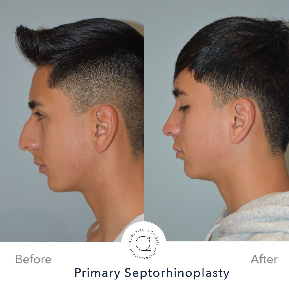 Rinoplastia Madrid caso 29 fotografía 3