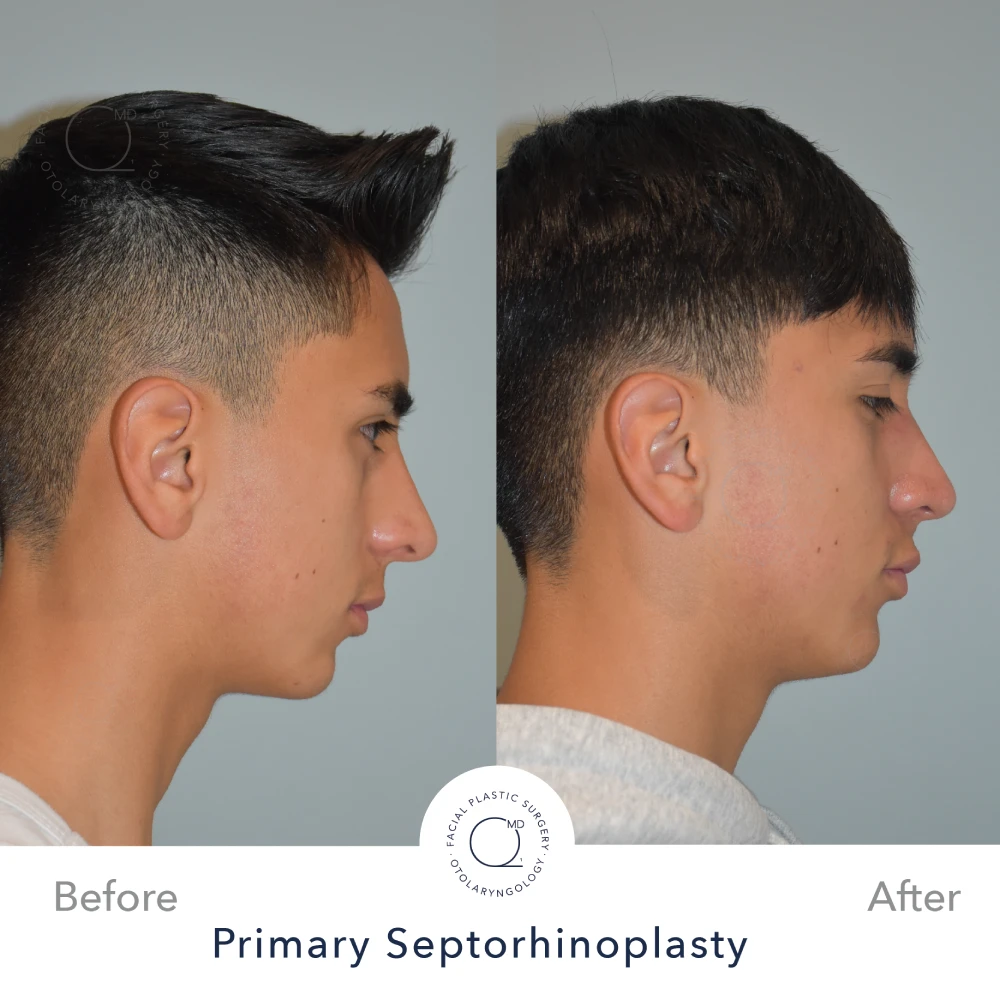 Rinoplastia Madrid caso 29 fotografía 4