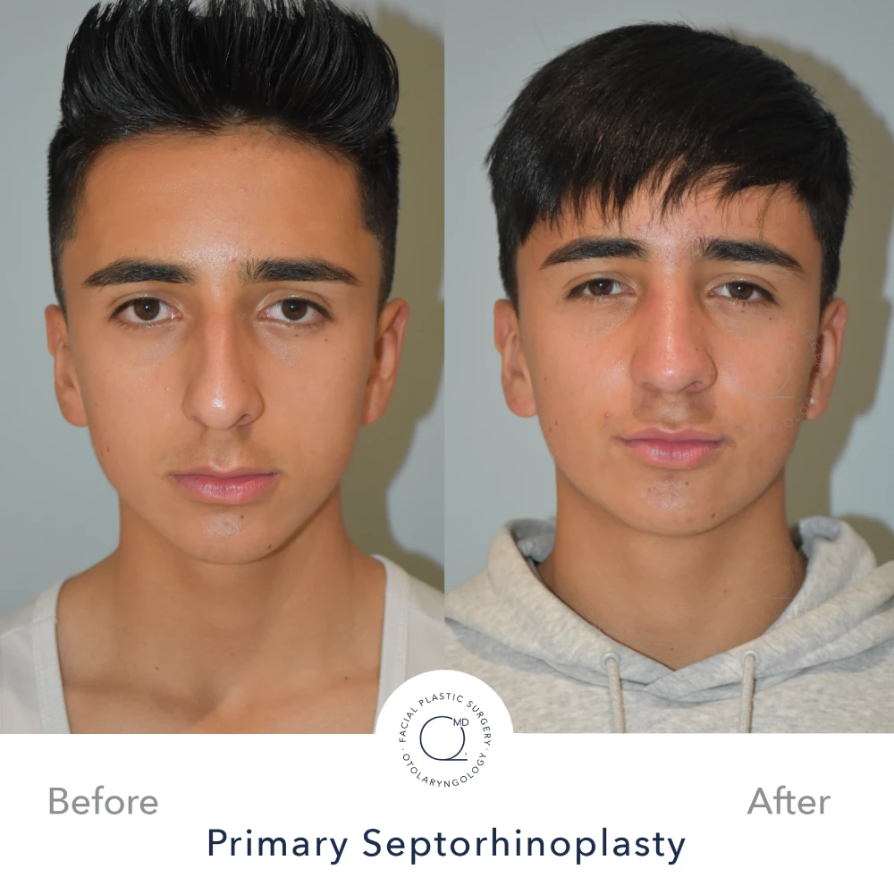 Rinoplastia Madrid caso 29 fotografía 5