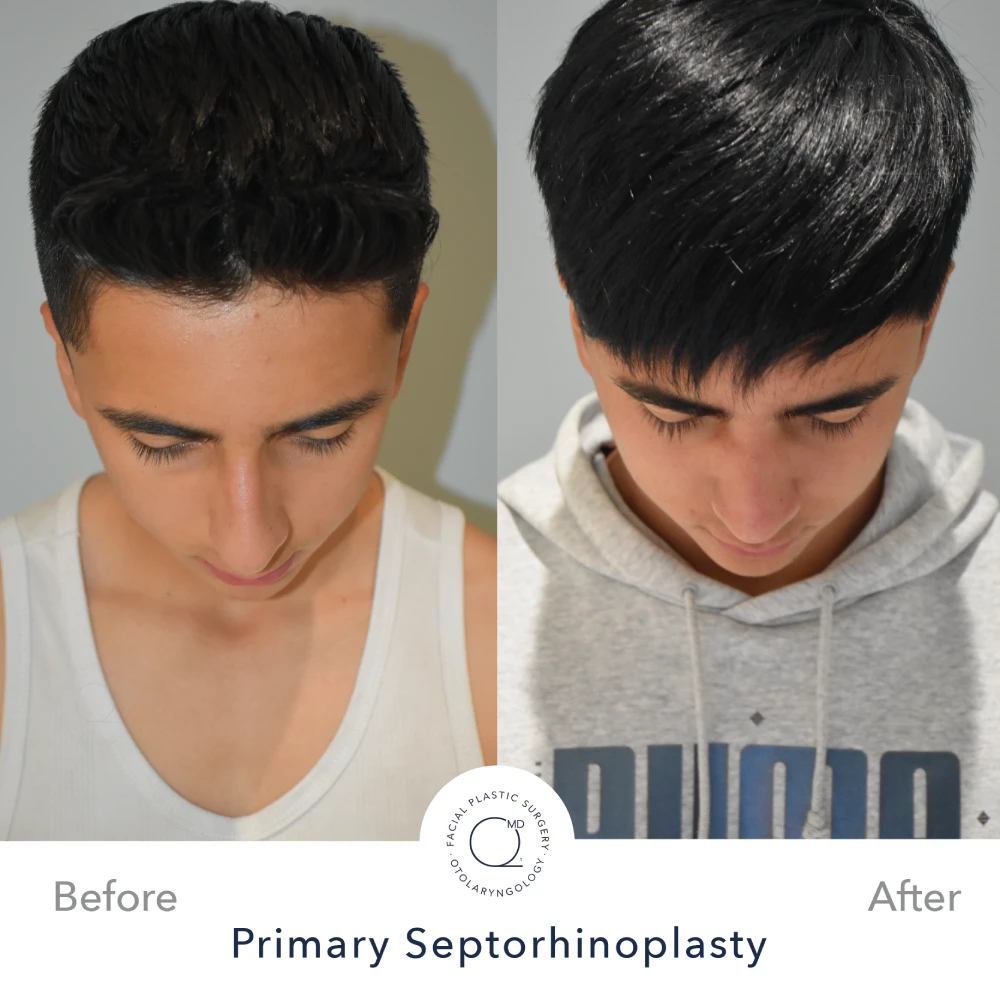 Rinoplastia Madrid caso 29 fotografía 6