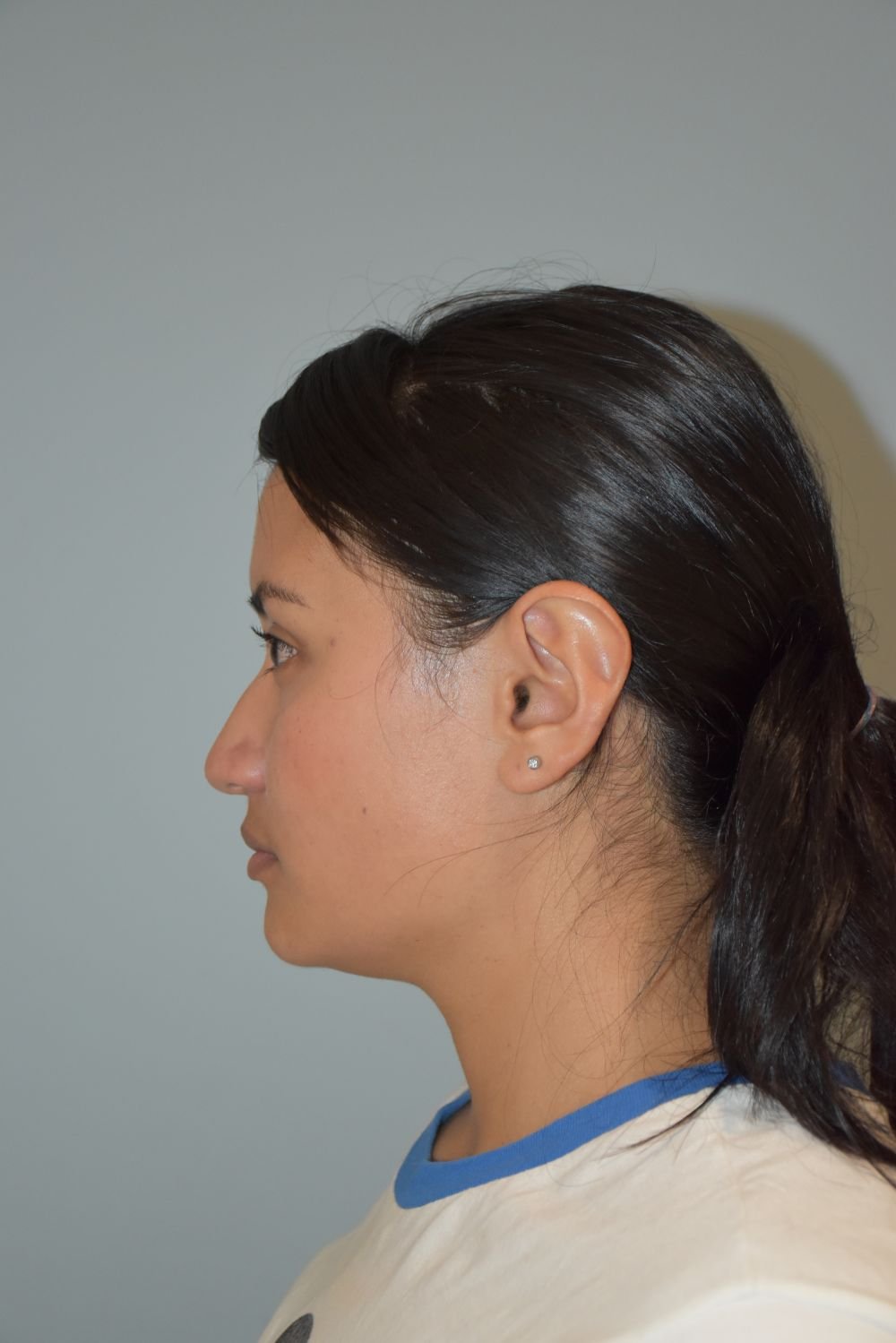 Rinoplastia Madrid caso 30 fotografía 1