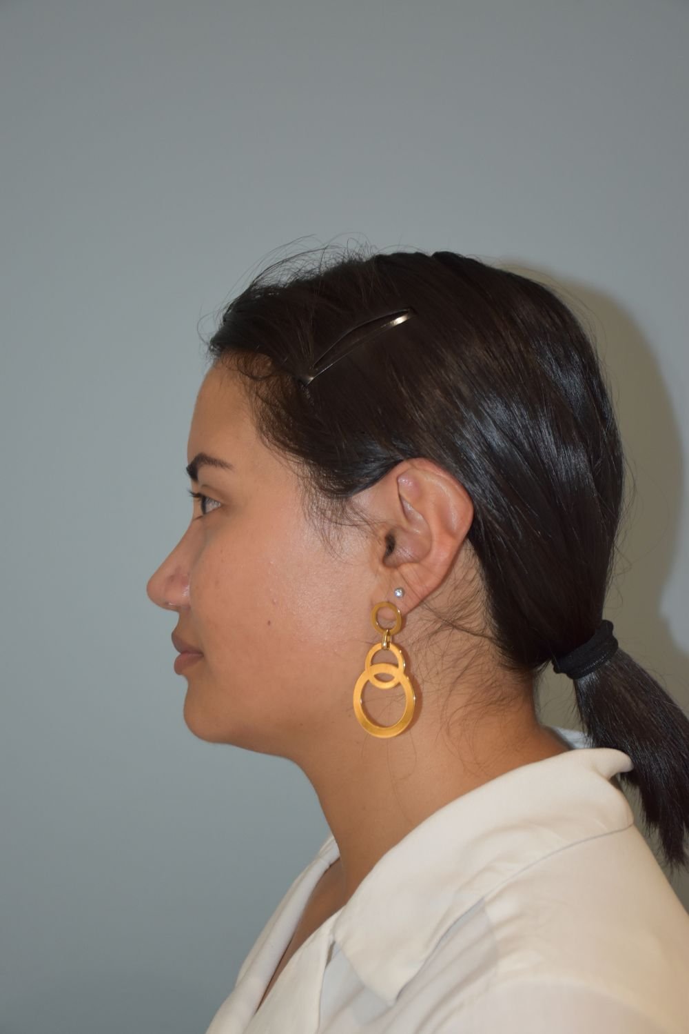Rinoplastia Madrid caso 30 fotografía 2