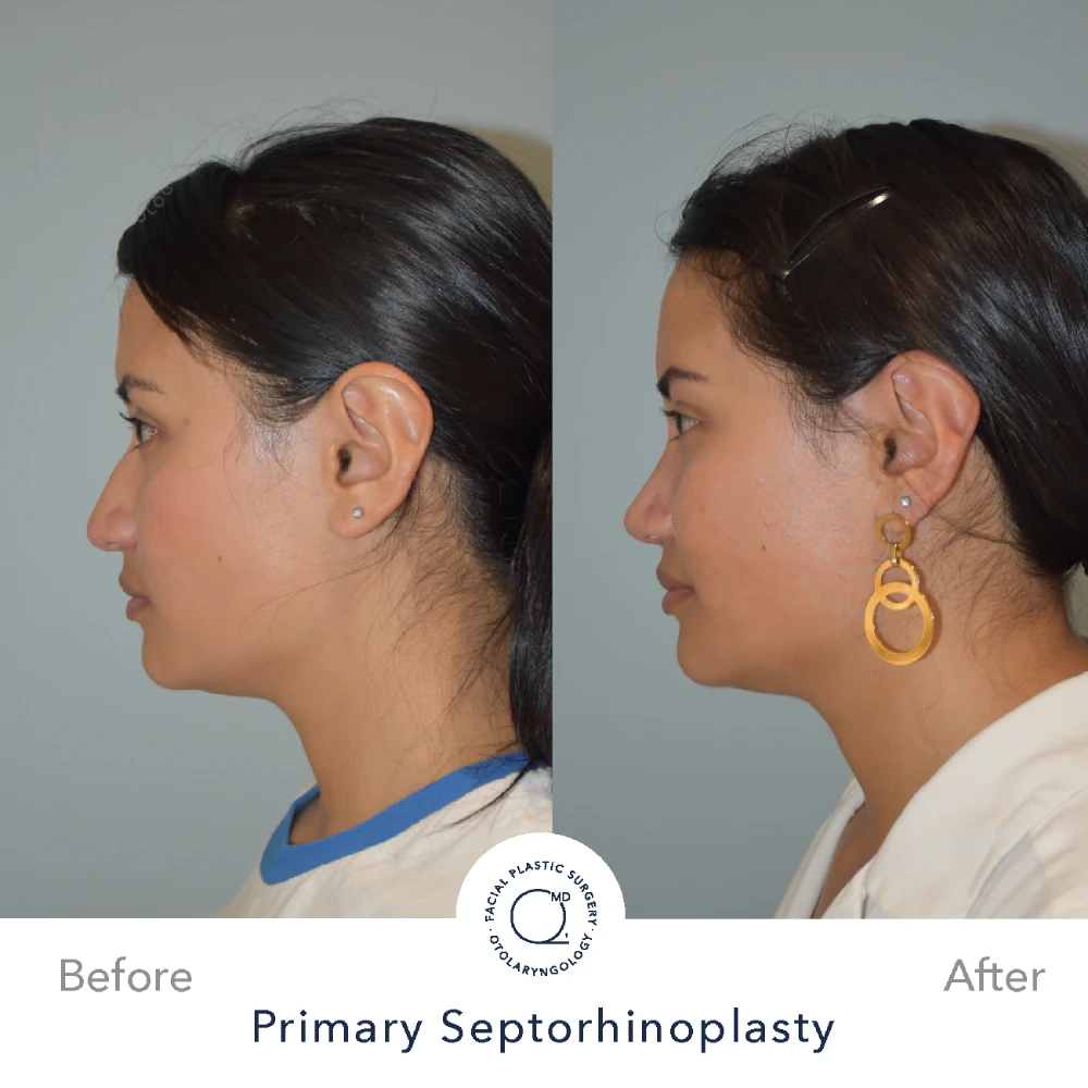 Rinoplastia Madrid caso 30 fotografía 3