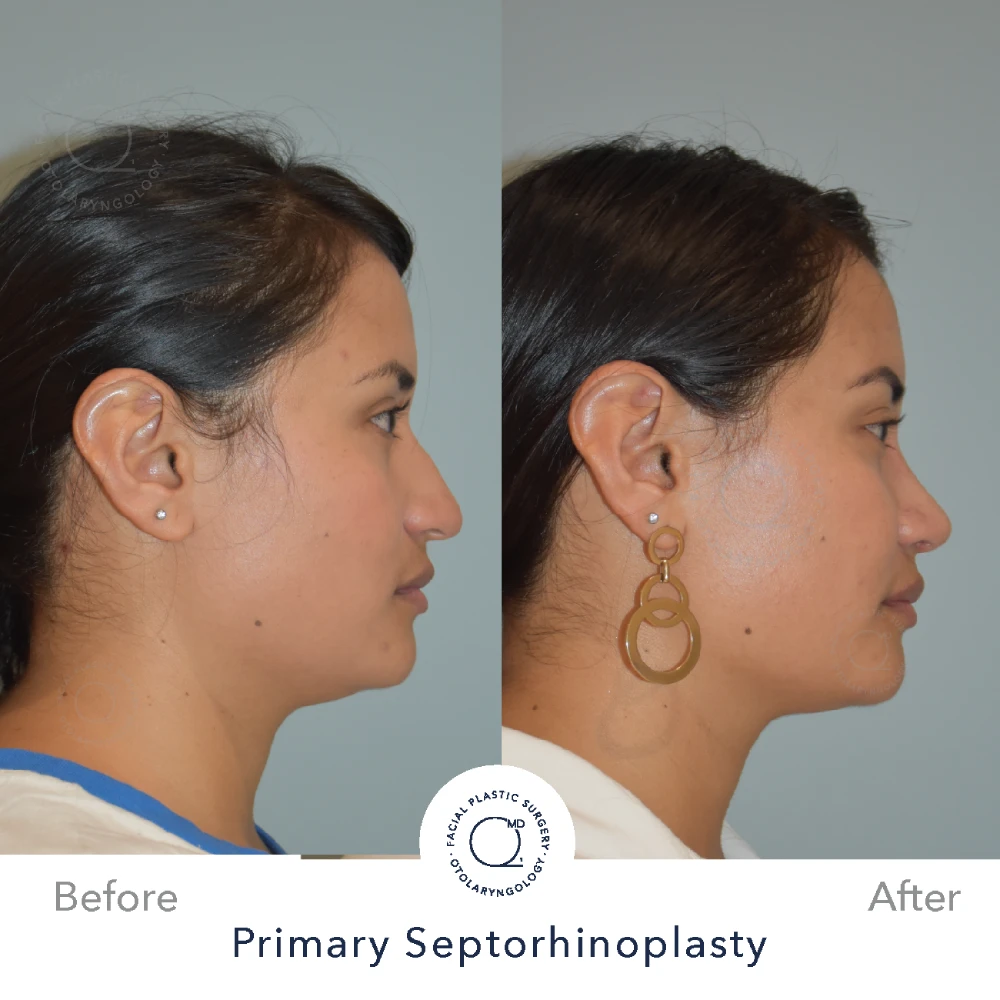 Rinoplastia Madrid caso 30 fotografía 4