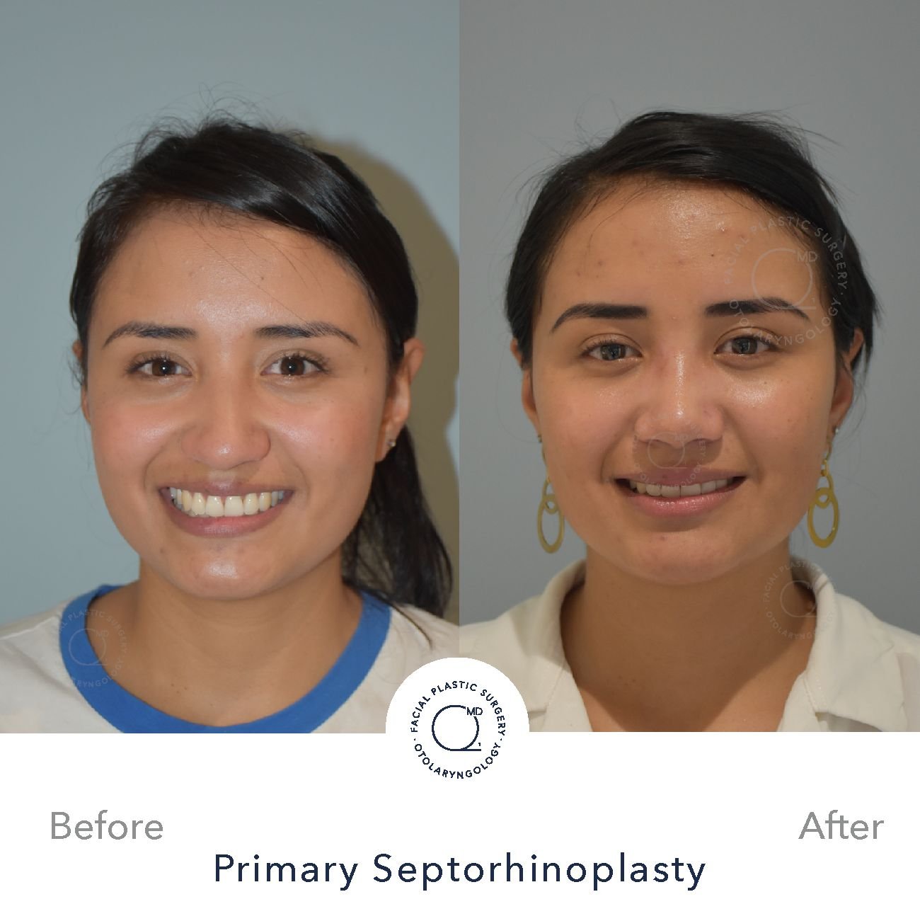 Rinoplastia Madrid caso 30 fotografía 5