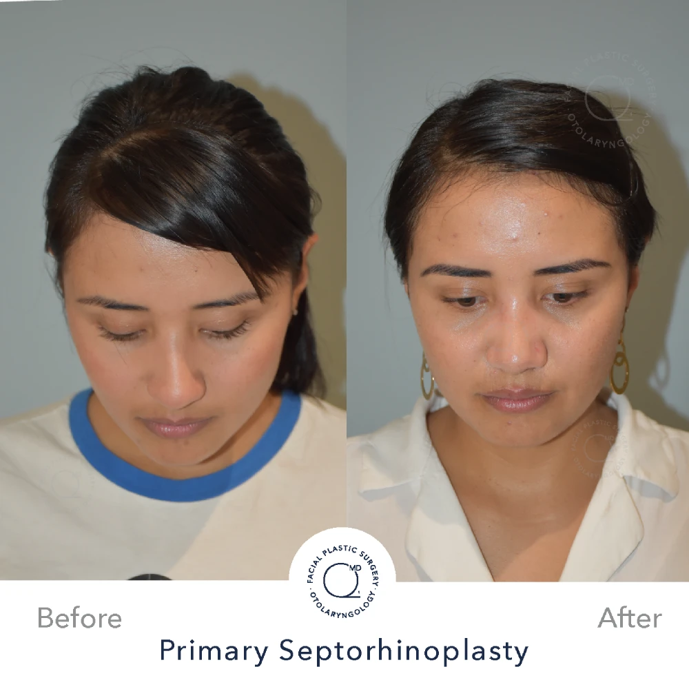 Rinoplastia Madrid caso 30 fotografía 6