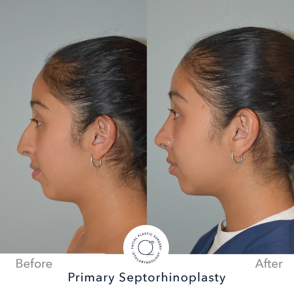 Rinoplastia Madrid caso 31 fotografía 3