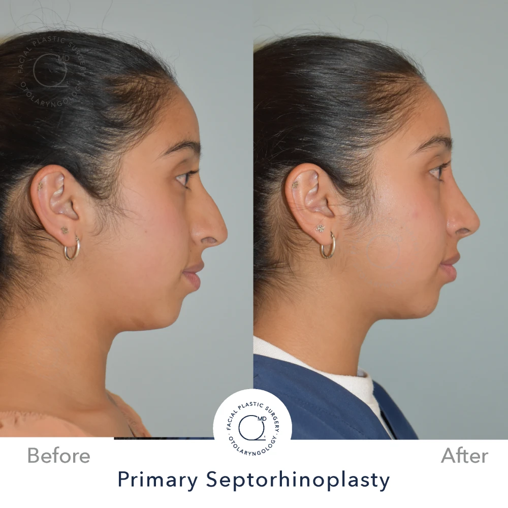 Rinoplastia Madrid caso 31 fotografía 4
