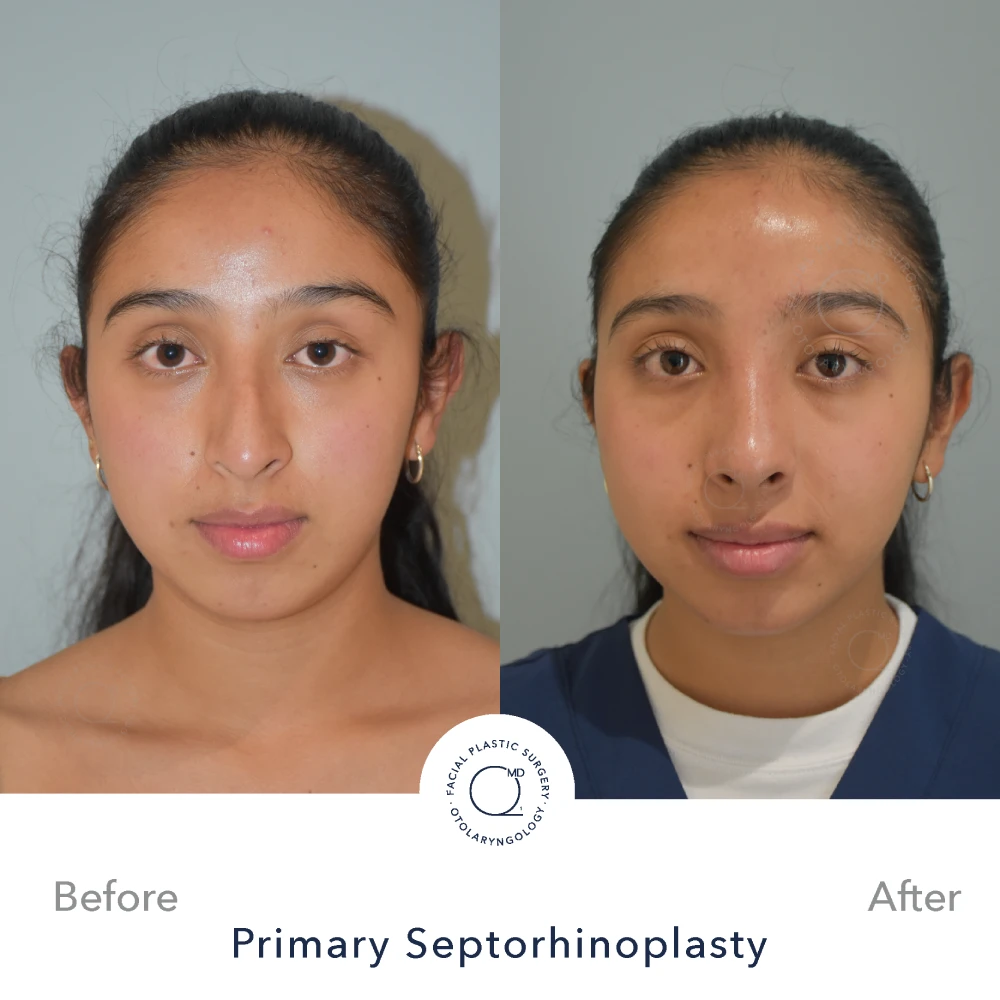 Rinoplastia Madrid caso 31 fotografía 5