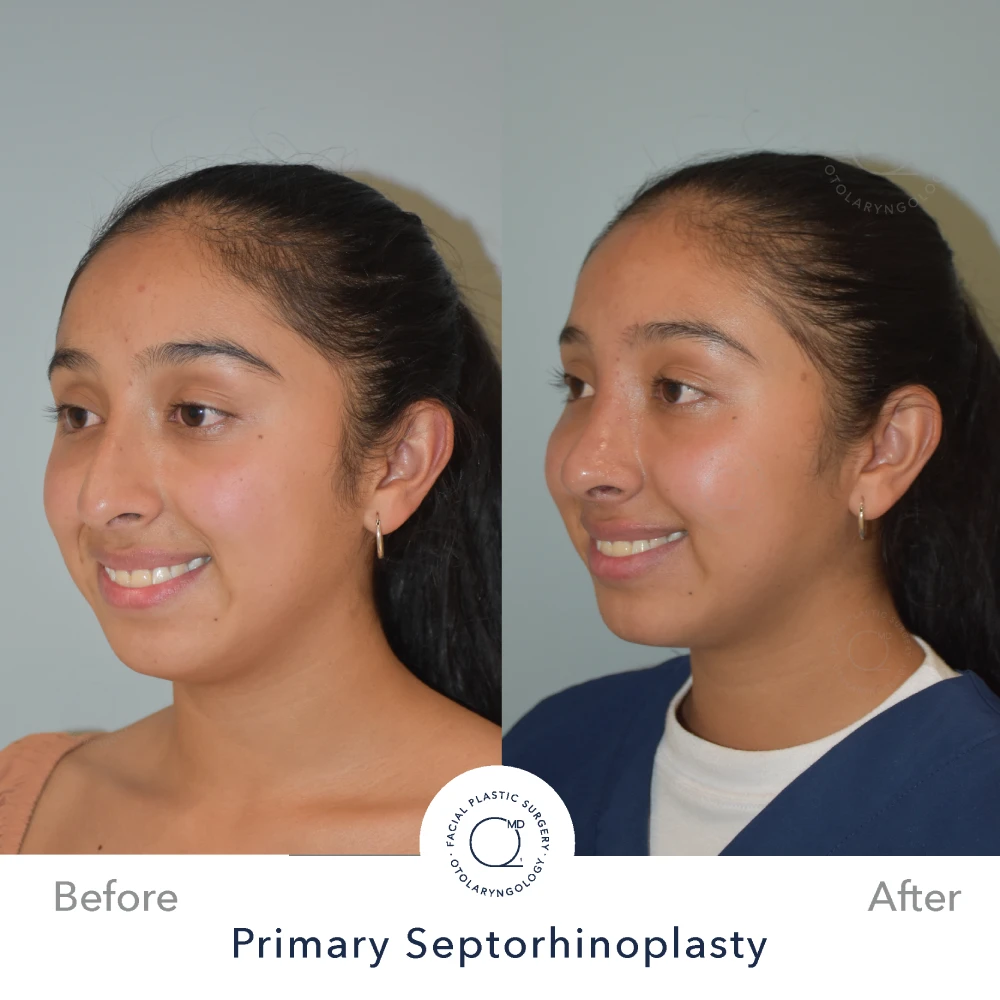 Rinoplastia Madrid caso 31 fotografía 6