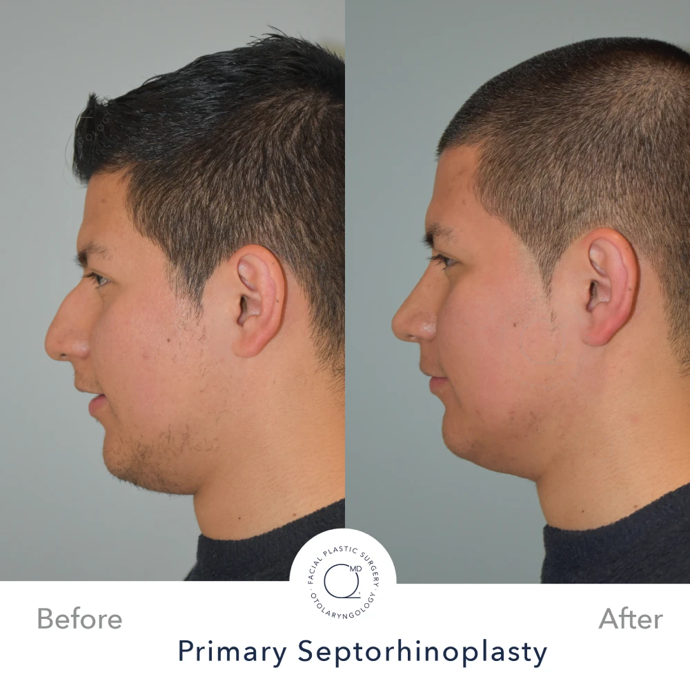 Rinoplastia Madrid caso 32 fotografía 3