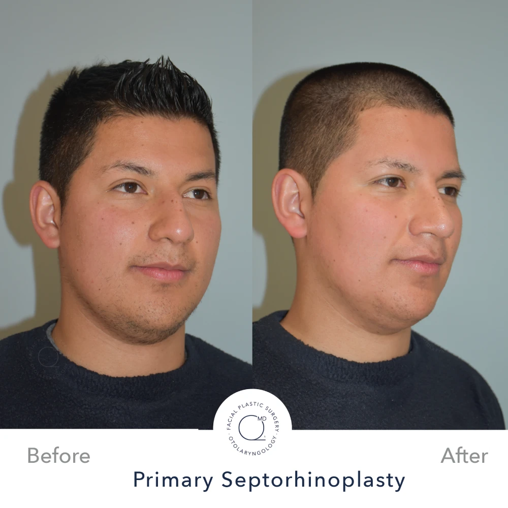 Rinoplastia Madrid caso 32 fotografía 4