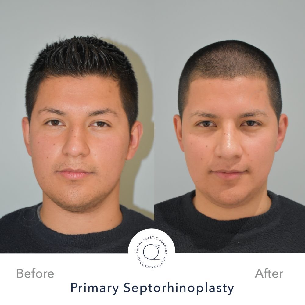 Rinoplastia Madrid caso 32 fotografía 5