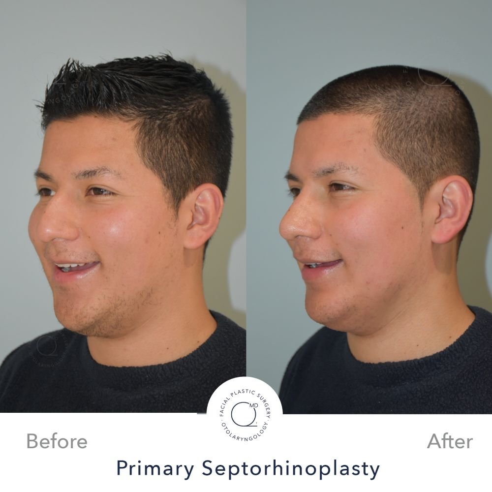 Rinoplastia Madrid caso 32 fotografía 6