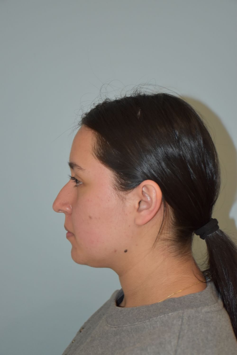 Rinoplastia Madrid caso 33 fotografía 1