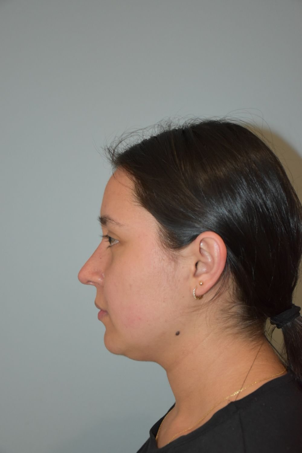 Rinoplastia Madrid caso 33 fotografía 2
