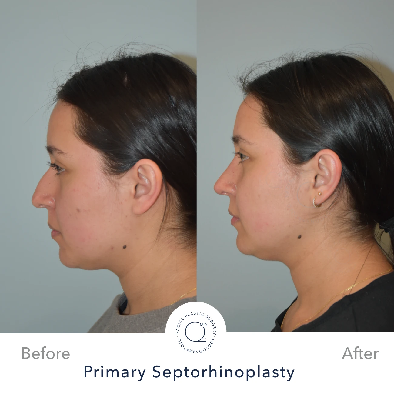 Rinoplastia Madrid caso 33 fotografía 3