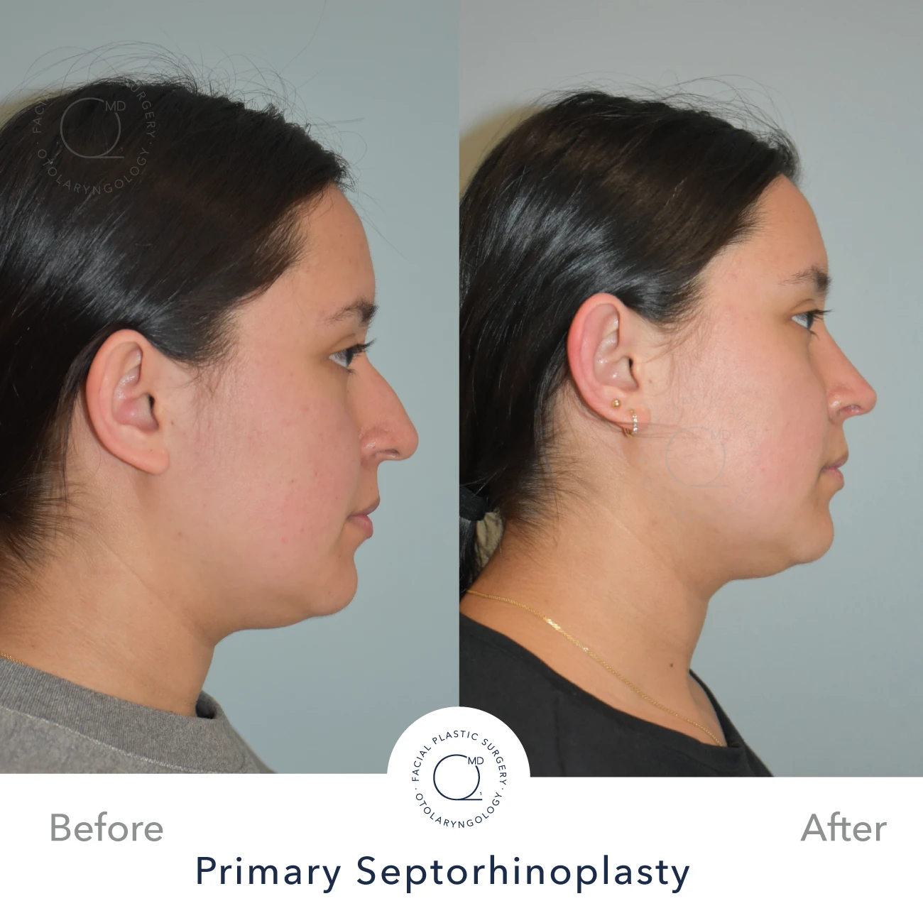 Rinoplastia Madrid caso 33 fotografía 4